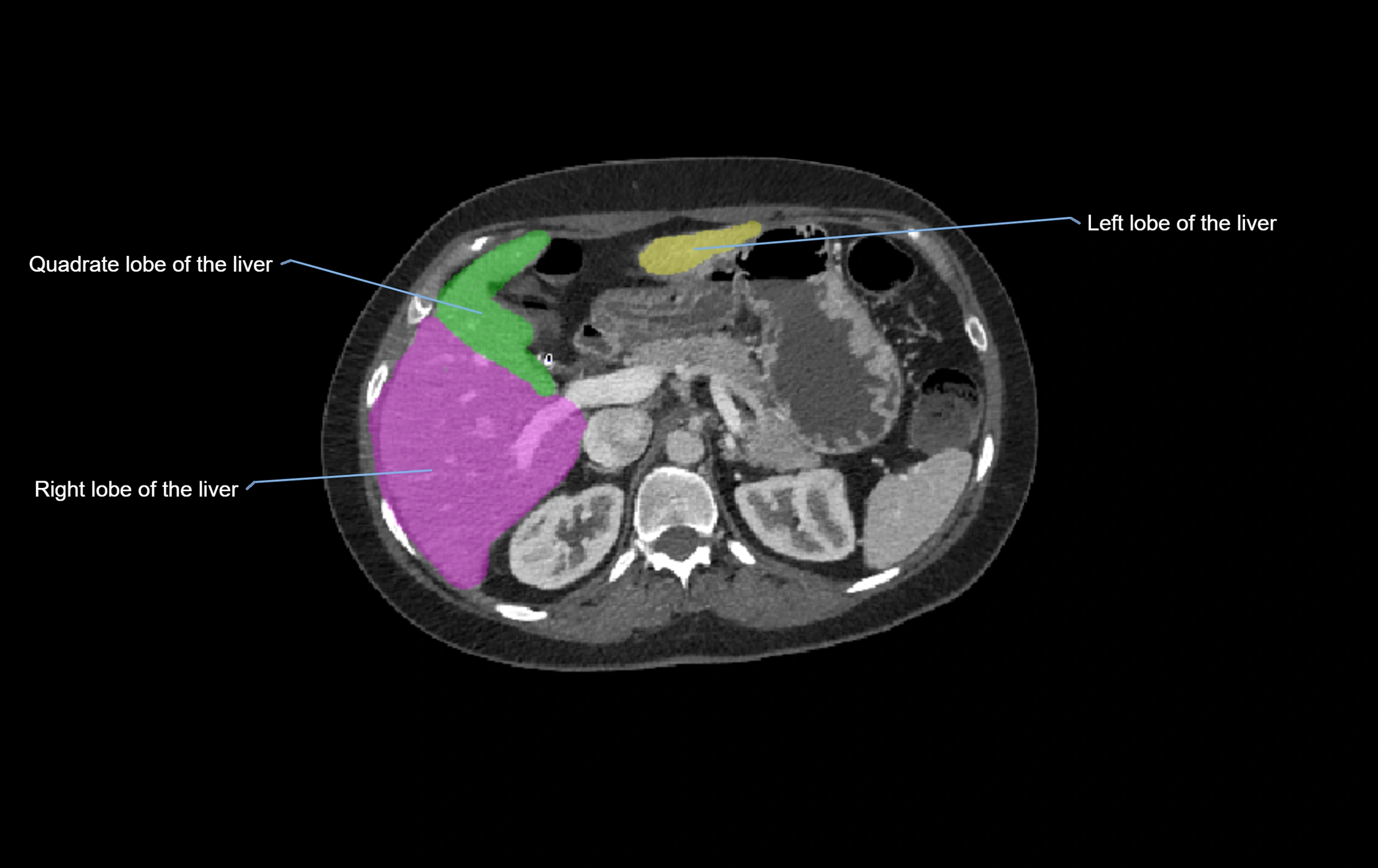 CT lliver lobes axial cross sectional anatomy labelled image -00041.webp